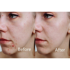 Aphrona LED facial mask, the ideal mask for your face