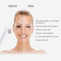 MLAY RF, l'appareil qui resserre la peau