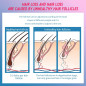 CNV Hair Regrowth System: Laser Therapy for Thicker, Fuller Hair - At Home! CNV Hair Regrowth System: Laser Therapy for Thicker, Fuller Hair - At Home!
