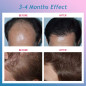 CNV Hair Regrowth System: Laser Therapy for Thicker, Fuller Hair - At Home! CNV Hair Regrowth System: Laser Therapy for Thicker, Fuller Hair - At Home!