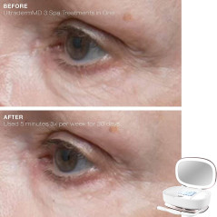 Trophy Skin UltradermMD: Microdermabrasion 3-en-1 à Domicile pour une Peau Éclatante!