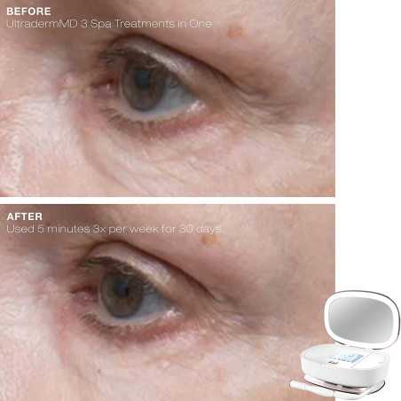 Trophy Skin UltradermMD: Microdermabrasion 3-en-1 à Domicile pour une Peau Éclatante!