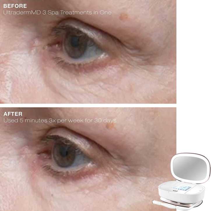 Trophy Skin UltradermMD: At-Home Microdermabrasion for Radiant, Youthful Skin Trophy Skin UltradermMD: At-Home Microdermabrasion for Radiant, Youthful Skin