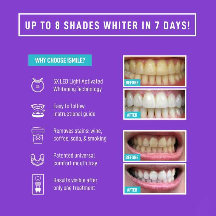 iSmile Advanced Teeth Whitening Kit: Get a Brighter Smile Fast with LED Light!