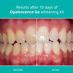 Opalescence Go, the teeth whitening trays