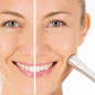 Beurer Microdermabrasion Kit: Reveal Radiant Skin at Home! Beurer Microdermabrasion Kit: Reveal Radiant Skin at Home!
