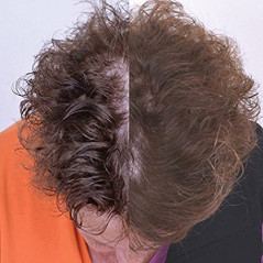 CapillusUltra Mobile Laser Therapy Cap for Hair Regrowth - NEW 6 Minute Flexible-Fitting Model - FDA-Cleared for Medical