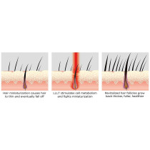 iRestore Essential Laser Hair Growth System | FDA Cleared Hair Regrowth Laser Cap - Red Light Therapy Hair Growth, Hair Loss
