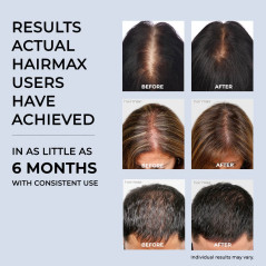 Laser Hair Growth Products (FDA Cleared) by Hairmax | Laser Hair Growth Cap | Model: RegrowMD | Hair Loss Treatment for Men and