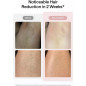 Ulike Air 10 IPL Hair Removal: Ice-Cooling, Dual Lights, Lasting Smoothness Ulike Air 10 IPL Hair Removal: Ice-Cooling, Dual Lights, Lasting Smoothness
