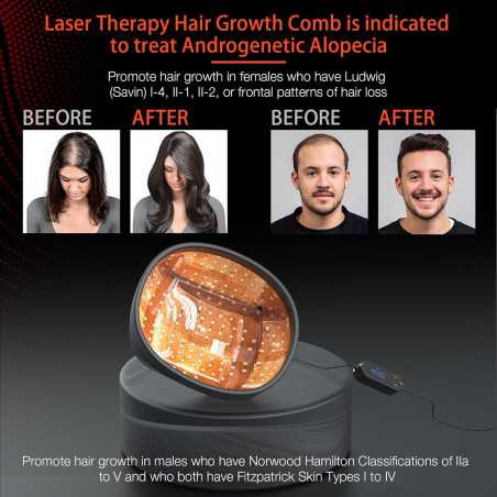 Laser Hair Growth Cap: FDA Cleared Red Light Therapy for Alopecia & Regrowth