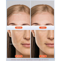 NEWKEY LED Face Mask Therapy for Wrinkles & Acne, 150 LEDs, Auto Off