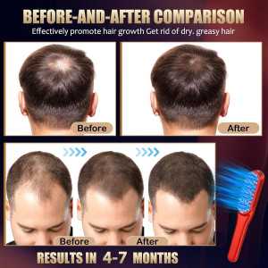 Peigne Laser Croissance Cheveux Rouge - Traitement Unisexe