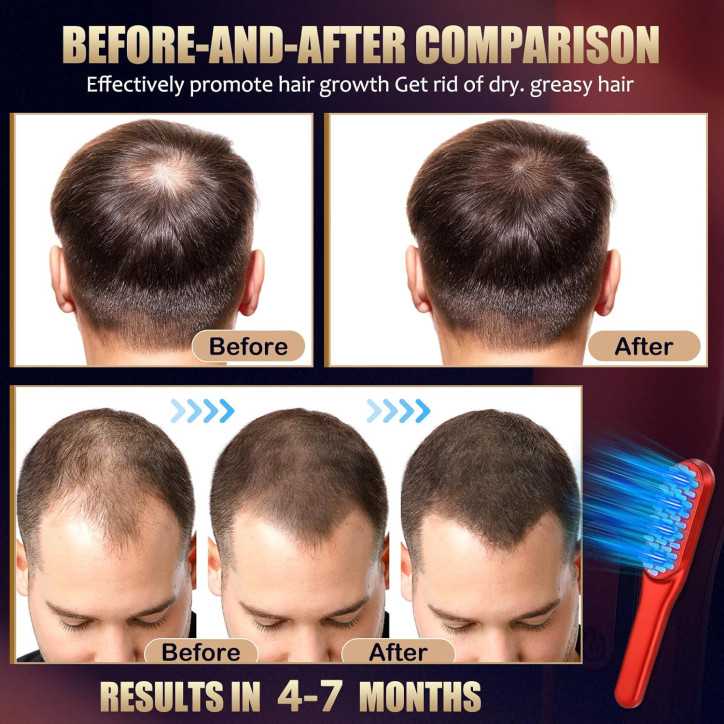 Peigne Laser de Croissance des Cheveux Rouge - Traitement pour Hommes et Femmes (1 pièce) Peigne Laser de Croissance des Cheveux Rouge - Traitement pour Hommes et Femmes (1 pièce)