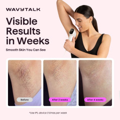 Wavytalk IPL Hair Removal Device – Painless Full Body, Long-Lasting Results