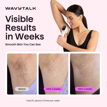 Wavytalk IPL Hair Removal Device – Painless Full Body, Long-Lasting Results