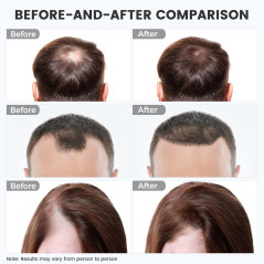 Cordless Red Light Therapy Cap for Hair Growth | Portable & Rechargeable